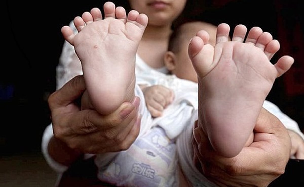 מקרה נדיר בסין: תינוק נולד עם 31 אצבעות