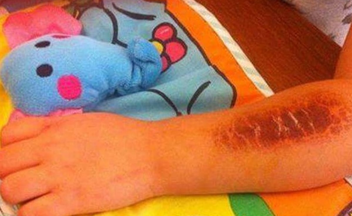 ספוג פלא גרם לזיהום ביד של ילדה בת ארבע