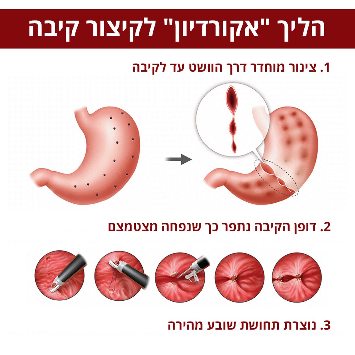 "אקורדיון" - תהליך קיצור קיבה הבטוח ביותר