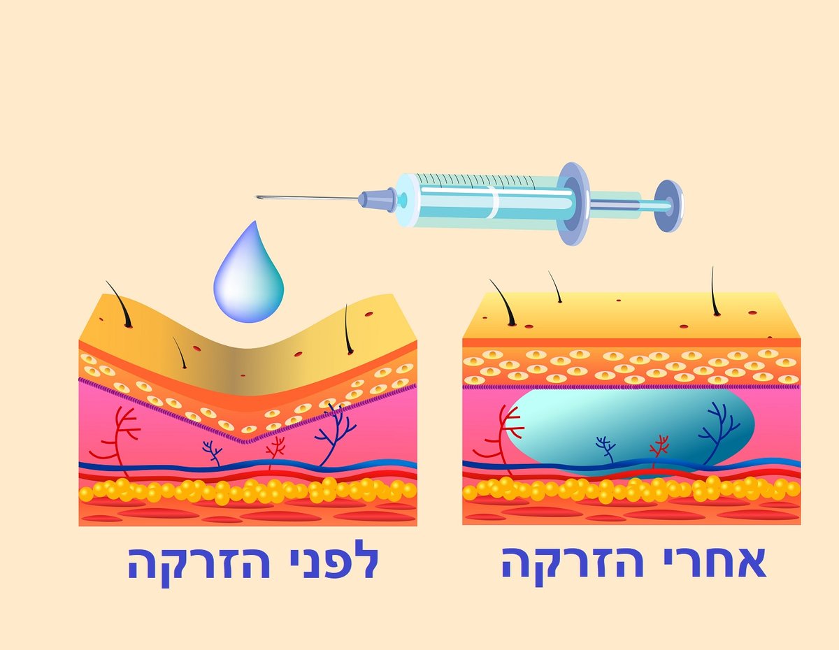 כך פועלת ההזרקה: אילוסטרציה