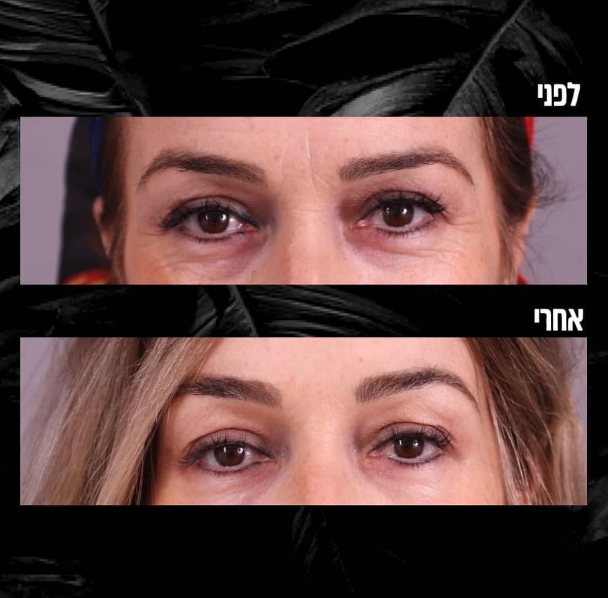 בוטוקס בקמטי צידי העיניים