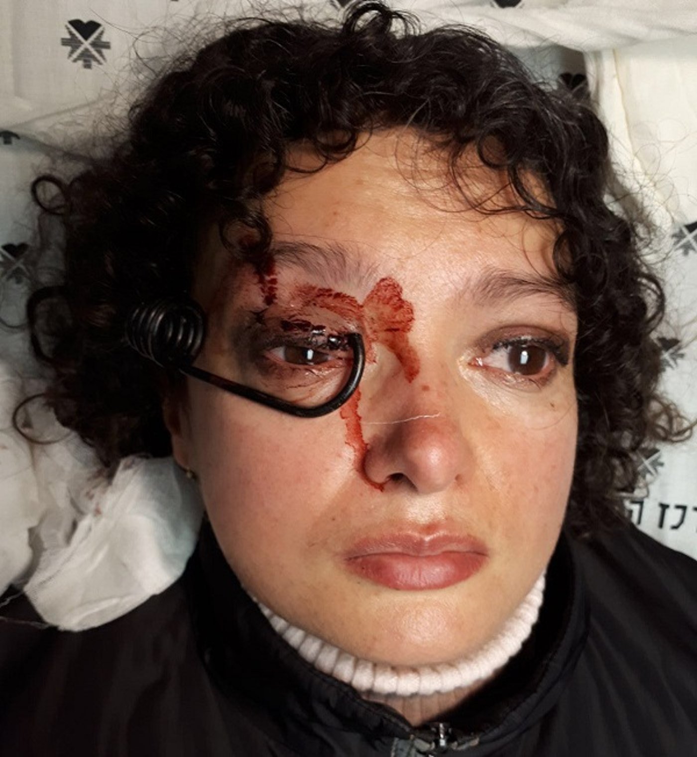 ניצלה בנס: וו העגלה קפץ ונתקע בתוך עין האישה