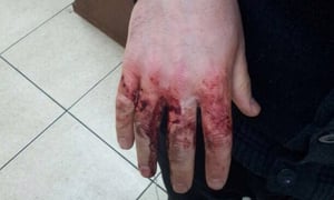 נדקר על ידי אנטישמים באוקראינה: ידו הפצועה של הלל כהן