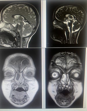 הדמיה, משמאל - לפני הוצאת רקמת המוח מהאף, מימין - לאחר הניתוח.