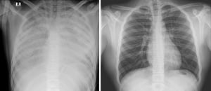 מימין צילום ריאות תקין. משמאל: צילום ריאותיו של הנער