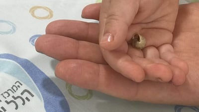 החילזון שחולץ מהאף