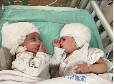 לראשונה בארץ: תאומות סיאמיות הופרדו