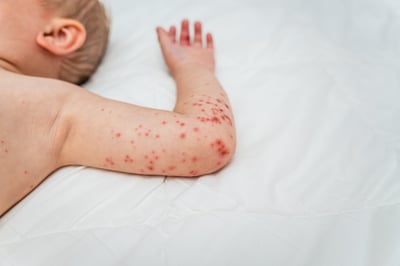 צילום: תסמיני החצבת