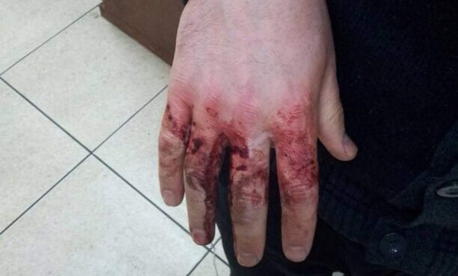 נדקר על ידי אנטישמים באוקראינה: ידו הפצועה של הלל כהן