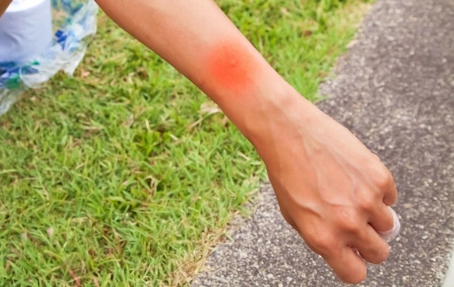 5 דרכים יעילות להימנע מעקיצות יתושים