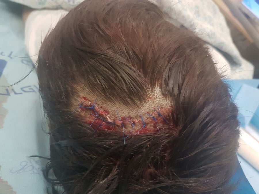 ילד בן 12 נפצע בחברון מאבן שפגעה בראשו