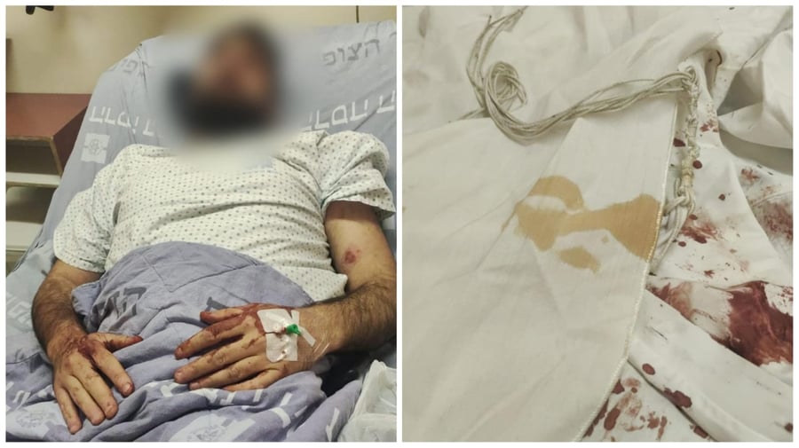 2 אחים הותקפו בידי פועלים ערבים ונפצעו