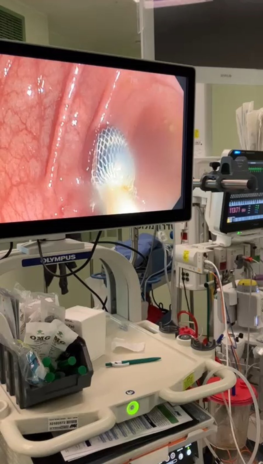 הפרוצדורה העדינה 