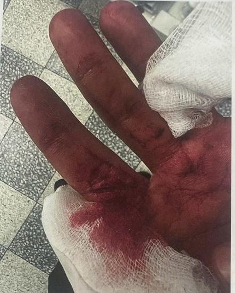היד הפצועה של הקצין