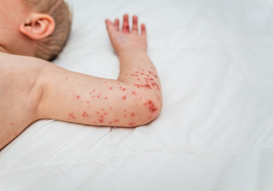 החצבת גובה עוד קרבן : ילד בן 6 הגיע במצב אנוש ונפטר בבית החולים